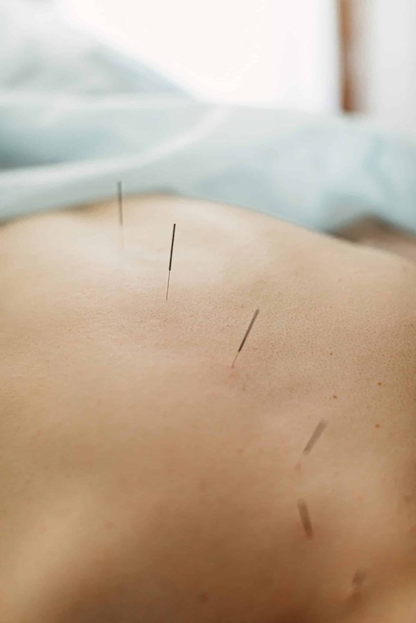L'acupuncture, une thérapie holistique millénaire aux applications multiples